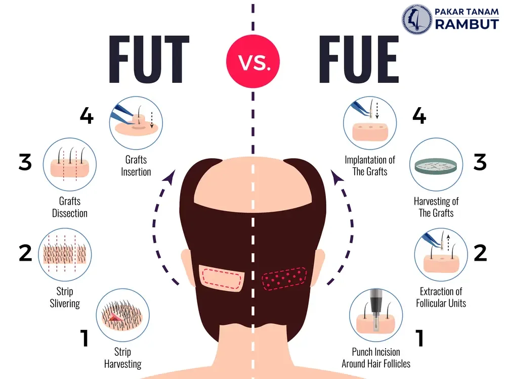 harga-tanam-rambut