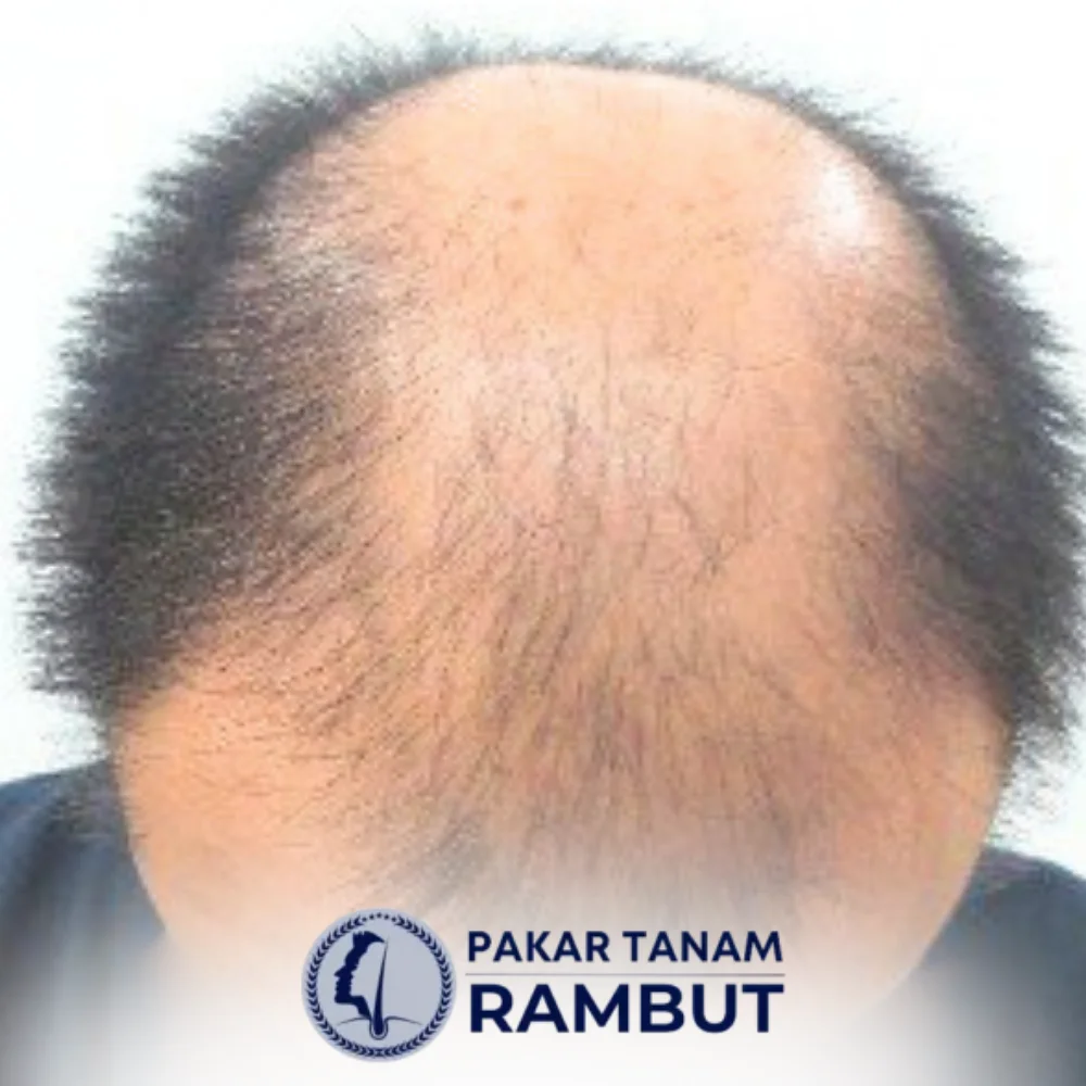 tanam-rambut-malaysia