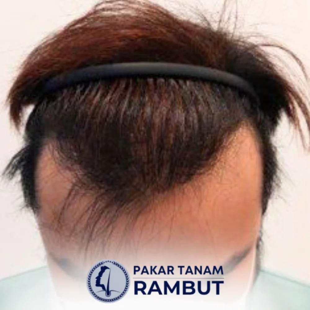 tanam-rambut-malaysia