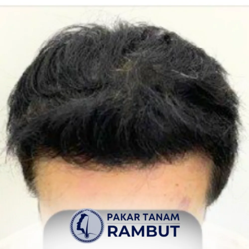 tanam-rambut-malaysia