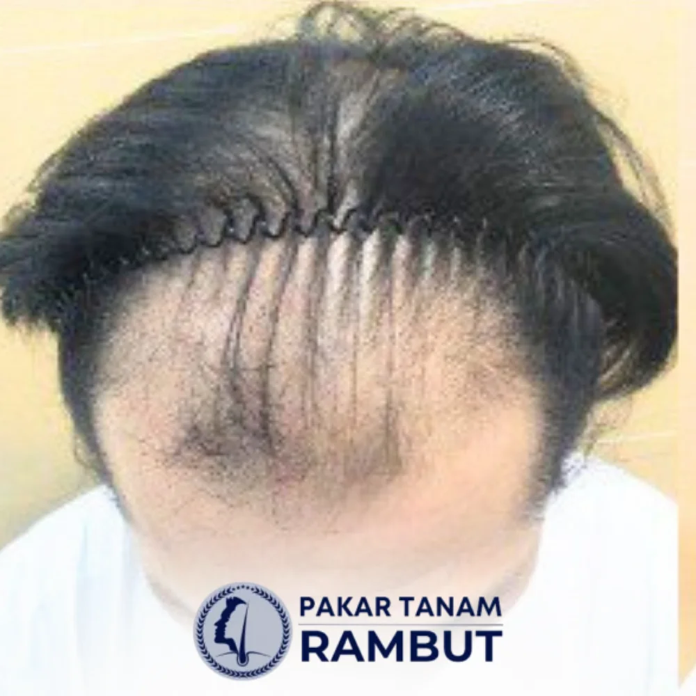 tanam-rambut-malaysia