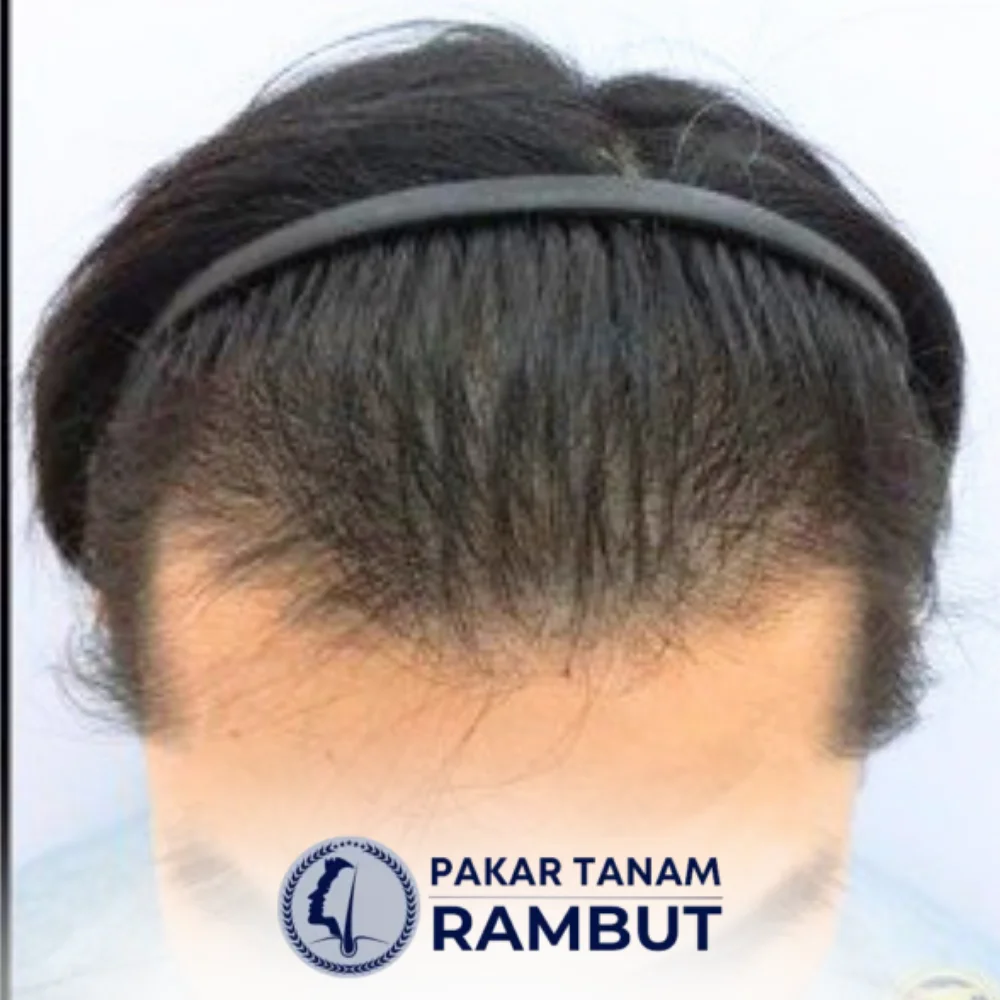 tanam-rambut-malaysia