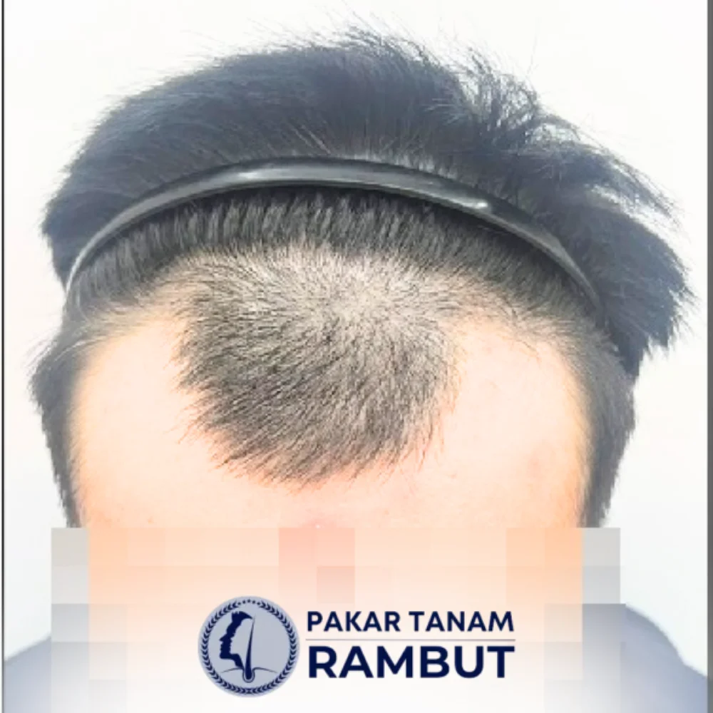 tanam-rambut-malaysia