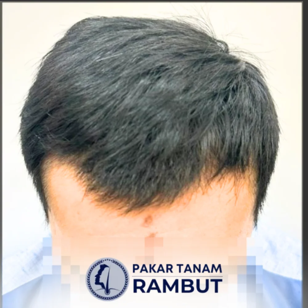 tanam-rambut-malaysia