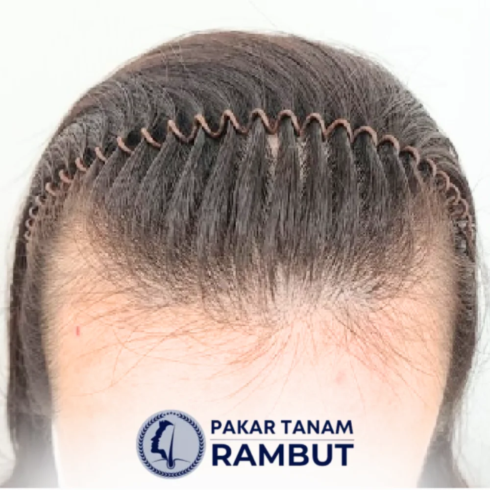 tanam-rambut-malaysia