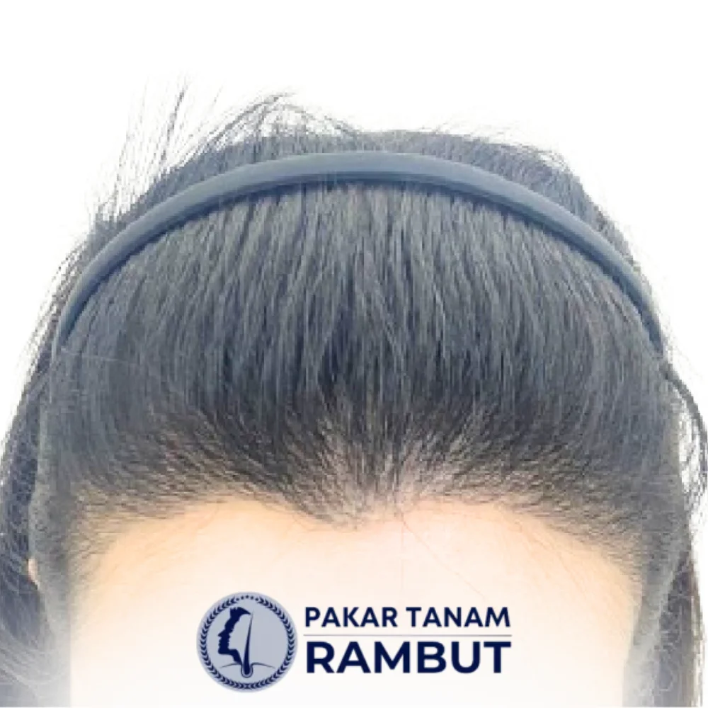 tanam-rambut-malaysia