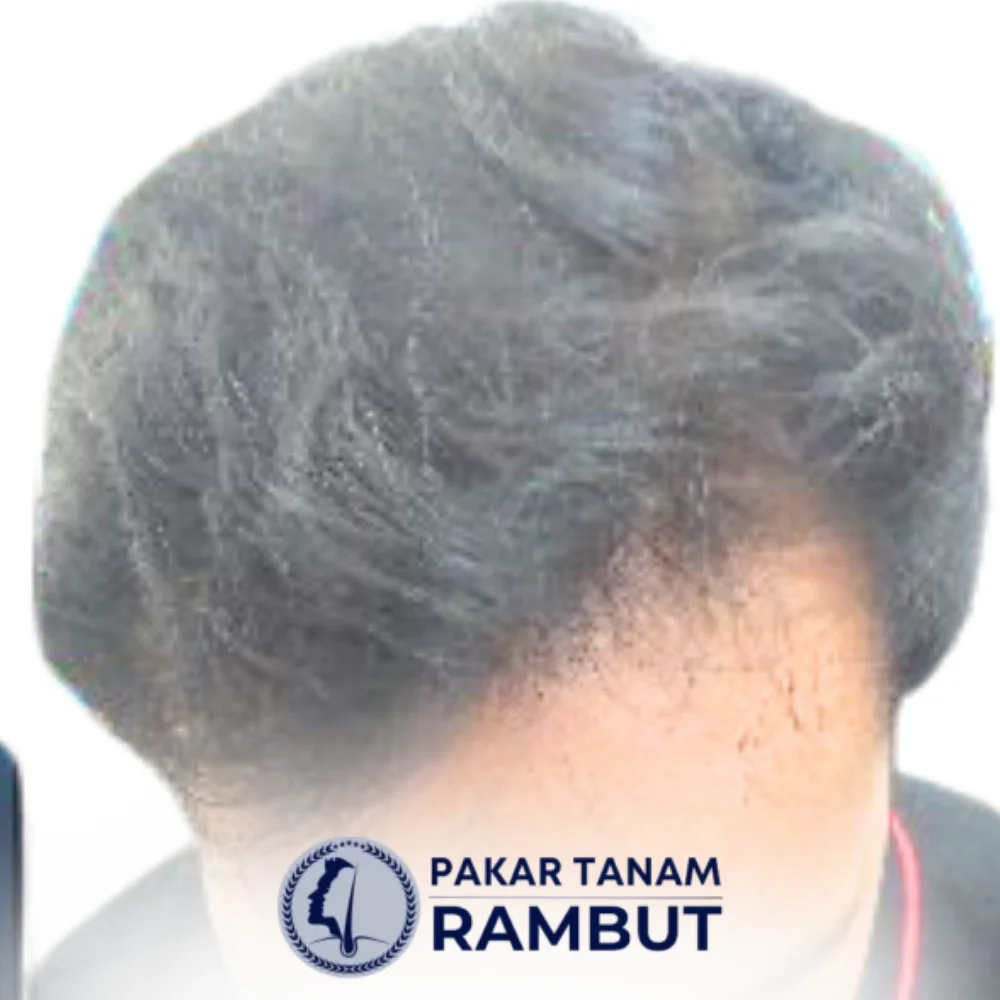 tanam-rambut-malaysia